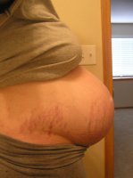 stretch marks.jpg