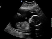 Baby2scanat20weeks.jpg