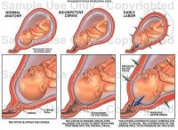 normaltofunnelingcervix_Full.jpg