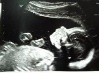 Baby #3 20 week scan.jpg