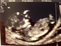 Baby Ultrasound 11 wk 5 days.jpg