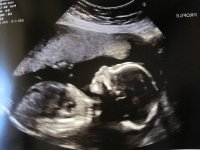 Liam 20 week scan.jpg