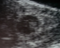 blurry ultrasound 7-8 weeks.png