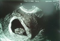 2nd Ultrasound 07August2014.jpg