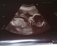 UB 20 week scan.jpg