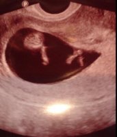 babytoes10w5d.jpg