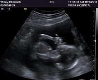 Ultrasound October 8 2014 Thumb Sucker.jpg