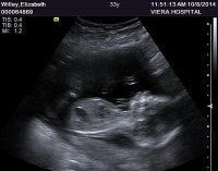 Ultrasound October 8 2014 Proflie.jpg