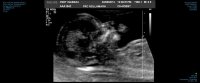 NOLL-NUCHAL TRANSLUCENCY 0001.jpg