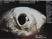 6 Week Ultrasound.jpe