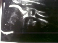 Baby Bottom @26weeks.jpg