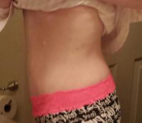Post surgery side.jpg