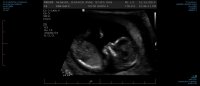 P2  NT OBSTETRIC ULTRASOUND 0001.jpg