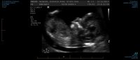 P2  NT OBSTETRIC ULTRASOUND 0003.jpg