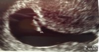 Ultrasound Pic with CRL 1-6-15 (deidentified).jpg