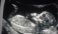 NT ultrasound full side view 2-13-15.jpg