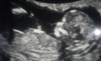 NT ultrasound side close up 2-13-15.jpg