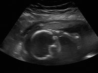 Henry ultrasound 5.jpg