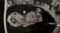 10 week scan.jpg