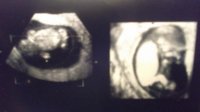ultrasouns2.jpg