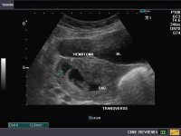 subchorionic-hematoma-1c.jpg