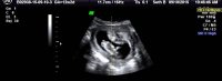12w4d ultrasound.jpg