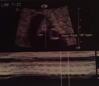 Ultrasound with HB crop.jpg