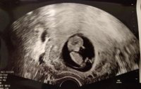 11 week scan.jpg