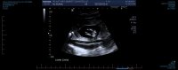 RNW-ULTRASOUND NUCHAL FOLD TS101389769 0031.jpg