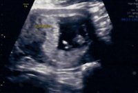 12W - placenta Ramzi's.jpg