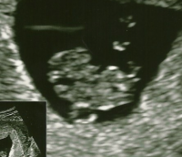 Ultrasound_120115_ThirdPic.png