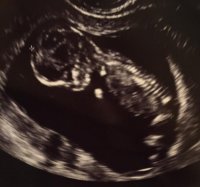 babyNTscan (2).jpg