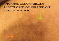 discolored areola.jpg