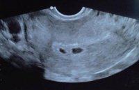 US 5 weeks 4 days.jpg