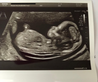 baby scan 13+2.png