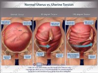 normal-uterus-vs-uterine-torsion-6.jpg