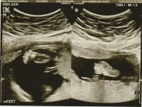 20 week ultrasound feet.jpg
