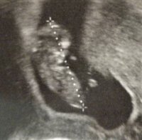 Ultrasound - 11w (small) (2).jpg