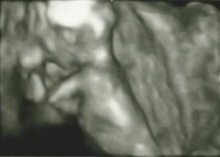 Ultrasound - 14w 3D.jpg
