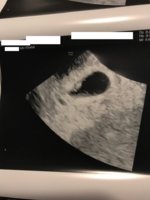 ultrasound5w6d-edited.jpg