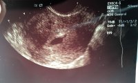 5 weeks and 4 days ultrasound saw yolk sac - Copy.jpg