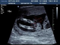 baby K 3 lines.jpg