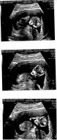 Ultrasound 12w4d.jpg