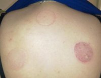 160410cupping.jpg