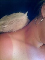 sunburn.jpg