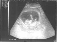 11 wk 5 day ultrasound1.jpg