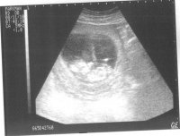 11 wk 5 day ultrasound2.jpg