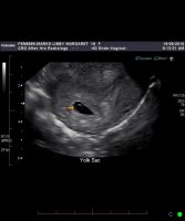 MY FIRST SCAN 5 AND A HALF WEEKS.jpg