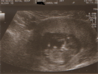 Ultrasounds 12 wks 1.png