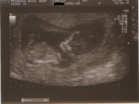 Ultrasounds 12 wks 2.png